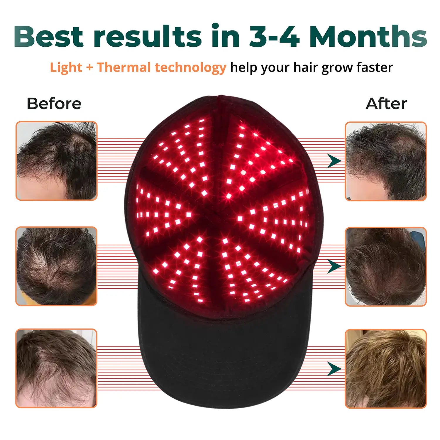 Red Light Therapy Device for Hair Growth